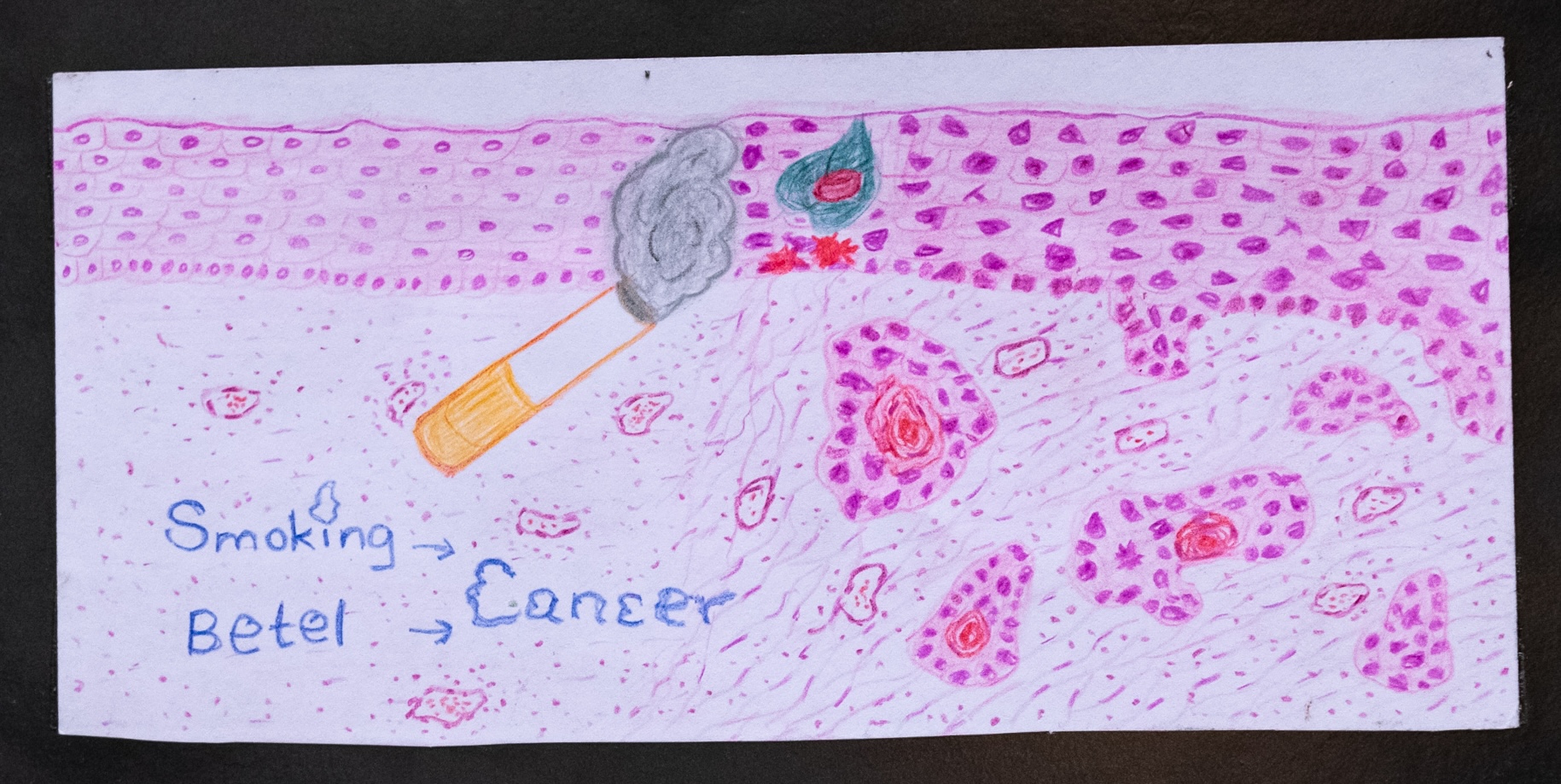 ‘Smoking & Betel —> Cancer’ by Dr Vinothika Sivamayuran